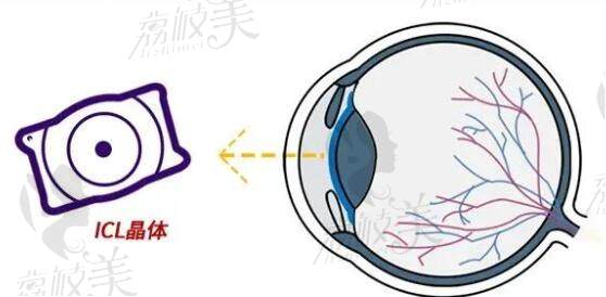 七百度近视可以做icl晶体植入手术吗？