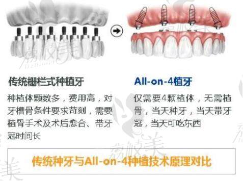 all-on-4种植牙技术和传统种植牙技术对比
