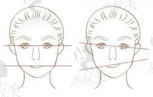 正常面部情况vs面部不对称