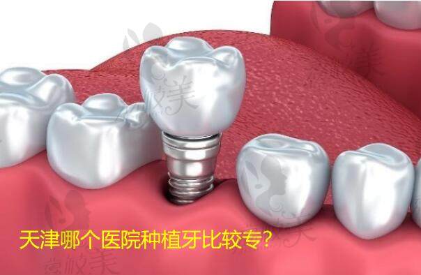 天津哪个医院种植牙比较专？