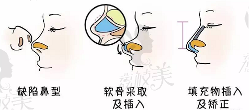 成都华美紫馨苏辰枫做鼻子流程