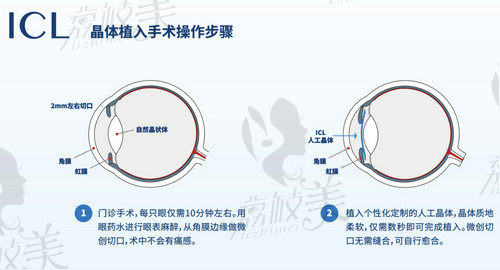 icl晶體植入手術(shù)的簡單介紹