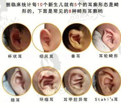 8种耳朵畸形的症状展示