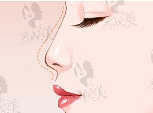 郑州李钢做鼻子技术好吗？