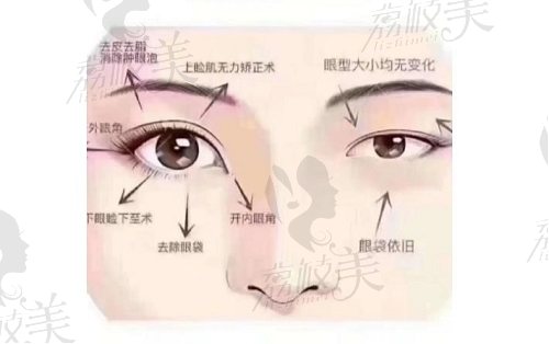 东莞九分美汪庆红做眼综合4580元起，审美自然技术可靠口碑杠杠的