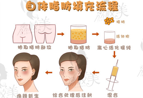 王跃星医生自体脂肪填充面部具备的手术特色