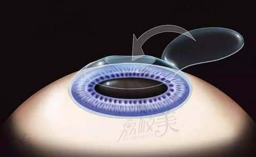 杭州茗视佳眼科激光近视手术技术出色