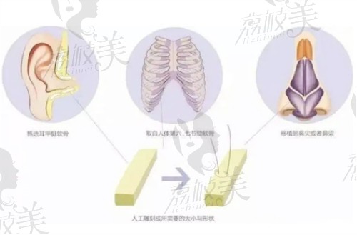 南京维多利亚整形李志生隐痕肋软骨隆鼻技术高超