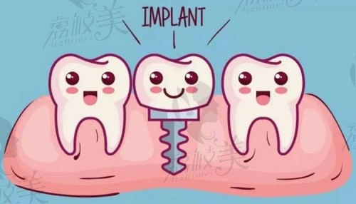 温州口腔种植牙价格
