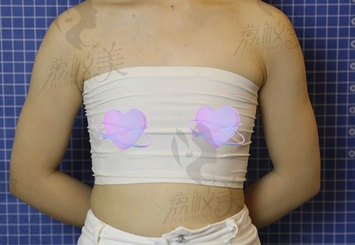 傲诺拉假体隆胸手术前图