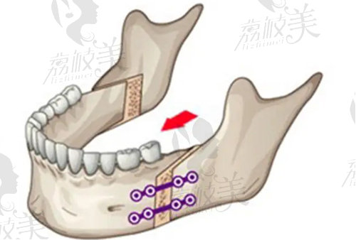 廣州美恩醫(yī)療美容正頜手術(shù)