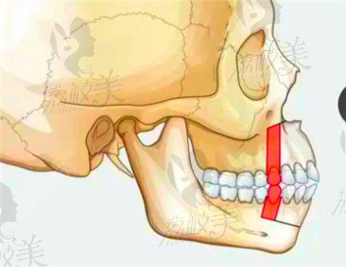 广州美恩医疗美容做正颌好不好