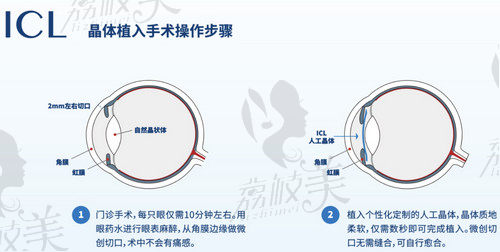 北京华德眼科医院丁振强医生做ICL晶体植入手术技术娴熟