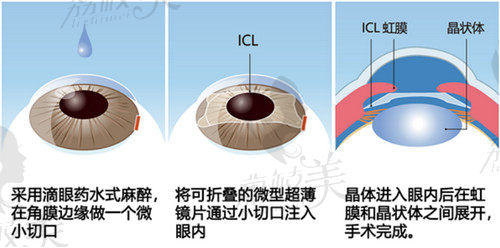 北京华德眼科医院丁振强医生做ICL晶体植入手术口碑不错