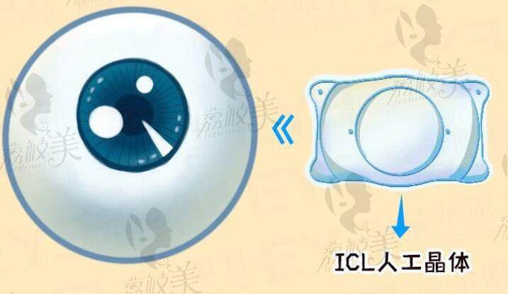 兰州爱尔眼科医院ICL人工晶体植入术