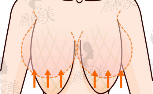 南京友誼縮胸手術(shù)技術(shù)成熟