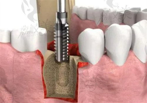 种植牙一共有几期手术