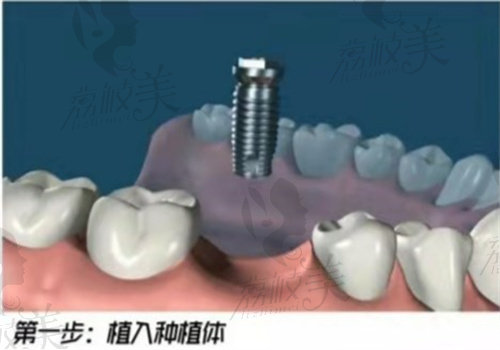 种植牙一共有几期手术
