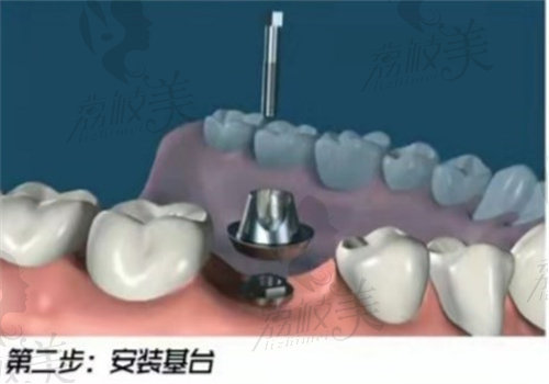 种植牙一共要分几次