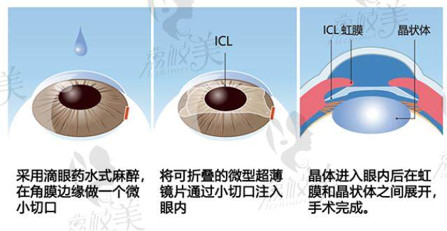晶体植入手术的过程