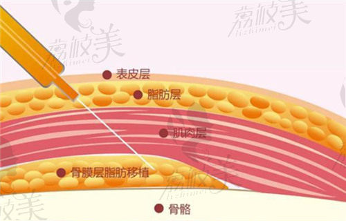 王世虎医生做面部脂肪填充技术好