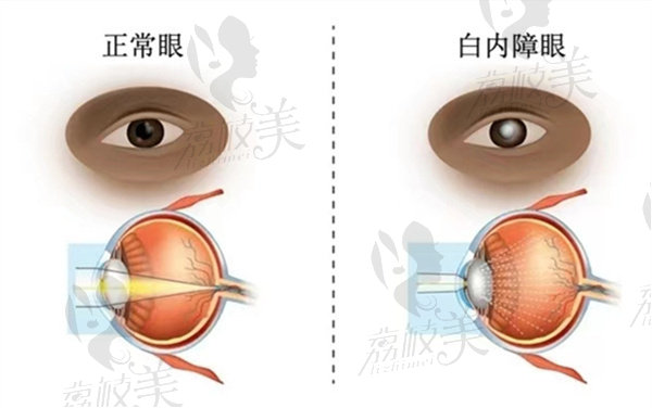 白内障的症状是什么原因引起的