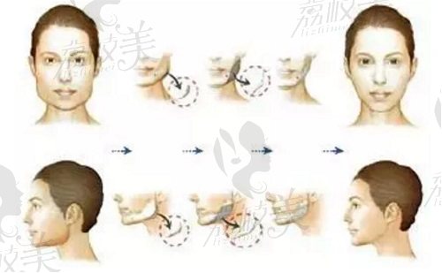 咬肌肥大切除手术过程