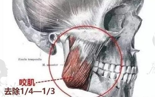 咬肌肥大切除手术切除量
