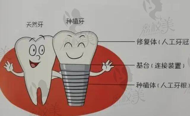 广州正规医院及广州正规医院种植牙收费标准