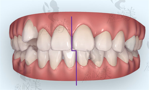 牙齿中线不齐有必要矫正吗