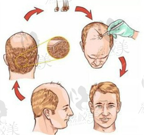 青岛熙朵头发移植注重术前的咨询和评估工作