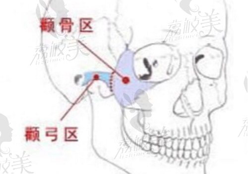 颧骨颧弓内推怎么样？