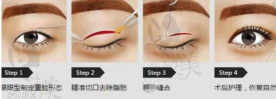 上海杜园园修复双眼皮怎么收费