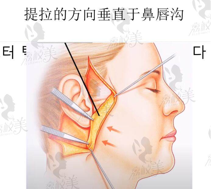 北京加減美黃寅守面部提升怎么樣