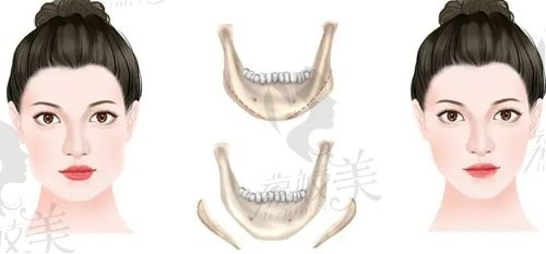 國內(nèi)做下頜角好的醫(yī)生朱石江