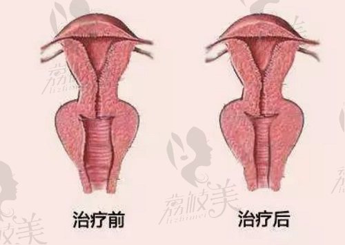 郑州紧缩阴道手术整形医院哪家好？