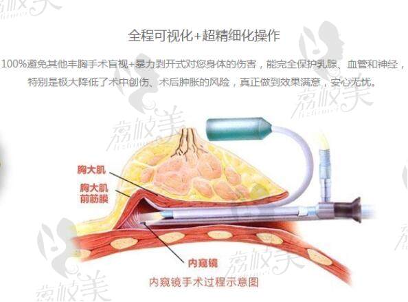 林沸騰醫(yī)生內窺鏡雙平米隆胸