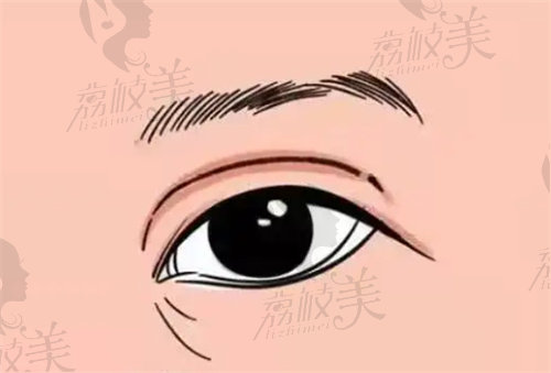 广州美恩整形医院的双眼皮修复医生技术优良