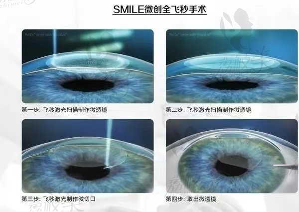 华厦眼科医院技术怎么样