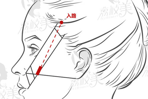 吕京陵医生做微拉美技术怎么样？