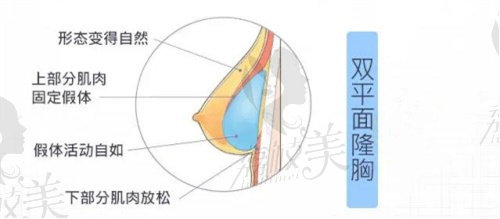 南京艺星医疗美容潘峰医生的曼托假体隆胸技术成熟