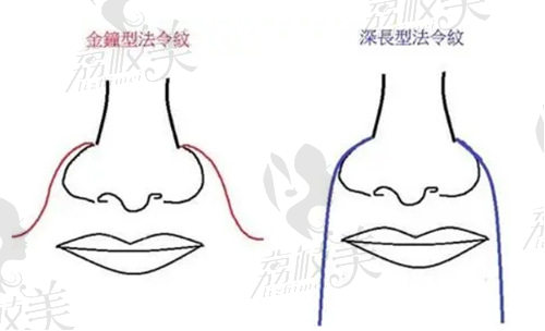 法令纹填充玻尿酸价格多少钱