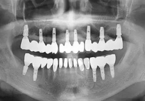 种植牙的年龄要求是怎么样的？种植牙的利与弊都有哪些呢？