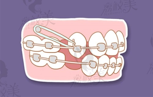 莆田爱牙口腔正畸技术