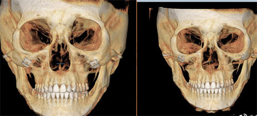 吴铭埈颧骨修复CT