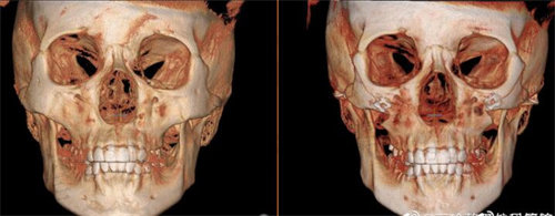 吴铭埈颧骨修复CT对比