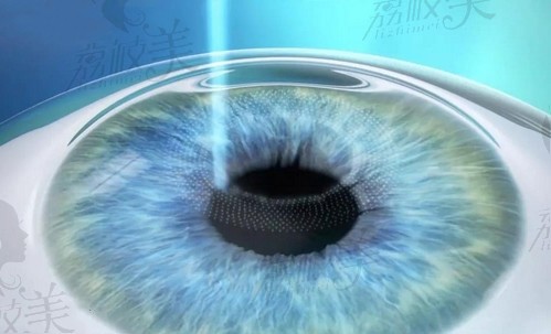 上海新视界眼科医院张晓琳做全飞秒激光手术很靠谱