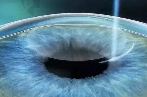 上海新视界眼科医院张晓琳做全飞秒激光手术技术扎实