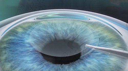 上海新视界眼科医院张晓琳做全飞秒激光手术技术娴熟