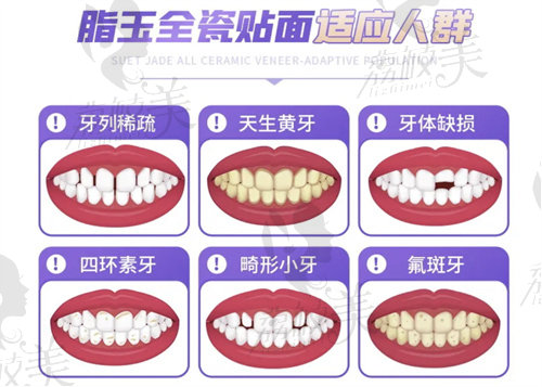 黄牙怎么治疗